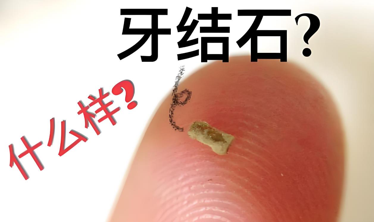 女生有牙結(jié)石會(huì)不會(huì)很尷尬,女生有牙結(jié)石怎么辦